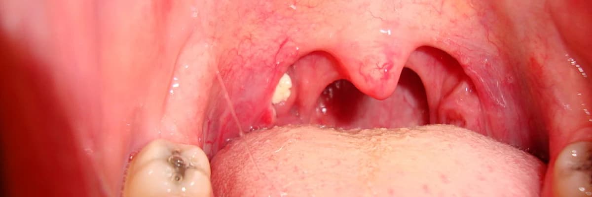 Bademcik taşı (tonsillolith)