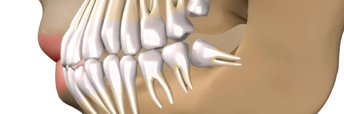 En çok sorulan sorulardan biri: 20 yaş dişi
