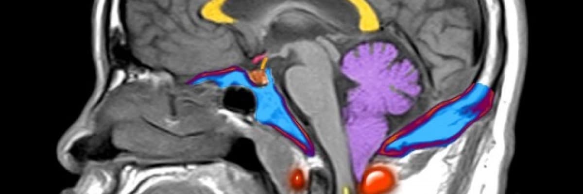 Chiari tip1 Malformasyonu