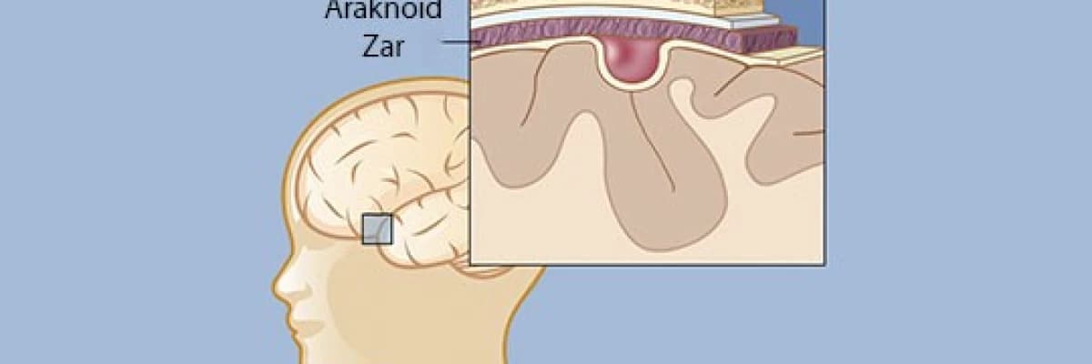 Araknoid kist nedir? Nasıl teşhis edilir?