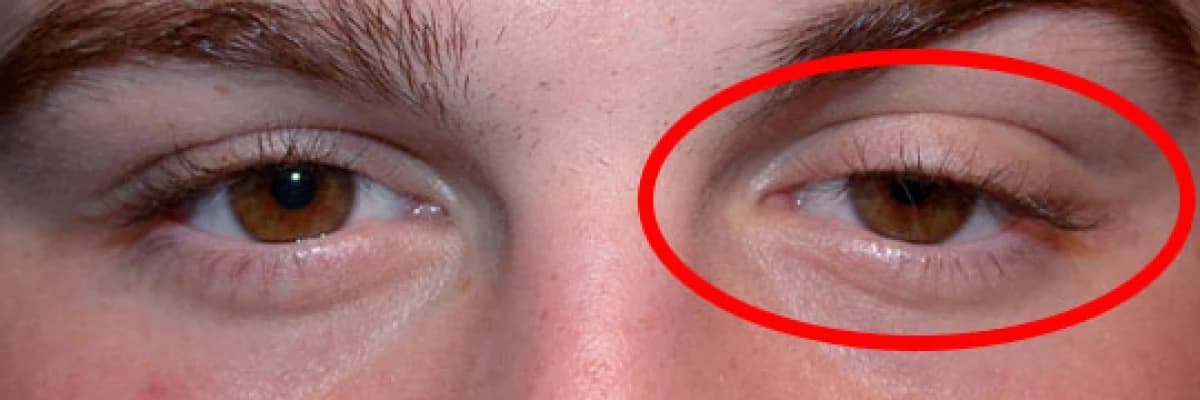 Tek taraflı göz kapağı düşmesi (pitozis)