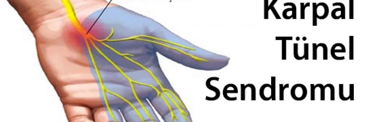 Karpal tünel sendromu (el bileği seviyesinde sinir sıkışması)