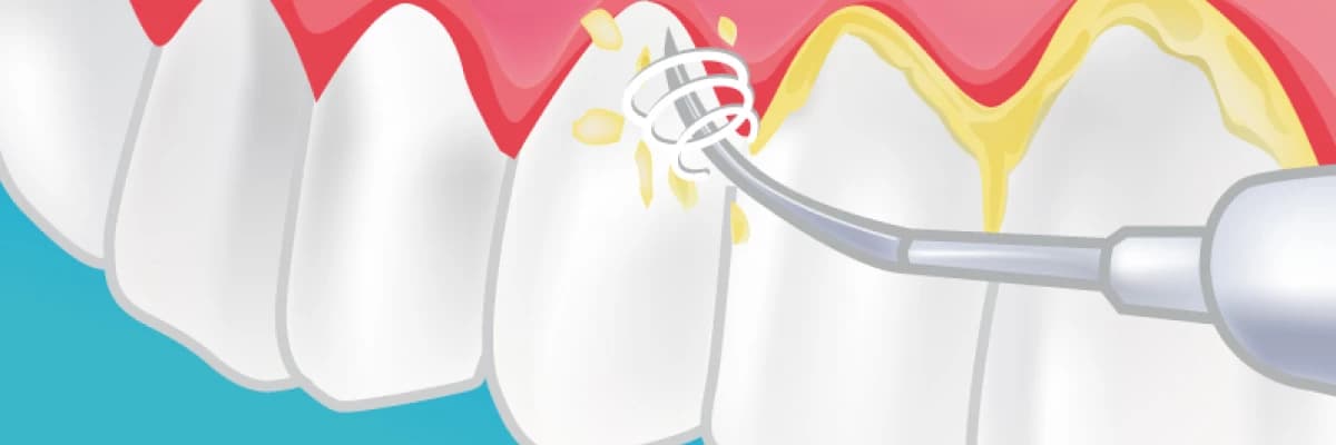 Dişleri temizletmek zararlı mıdır??