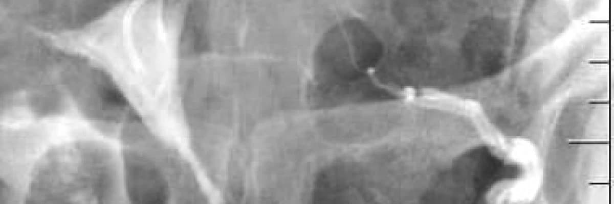 Tıkalı tüpler rahim filmi [HSG] ile açılır mı?