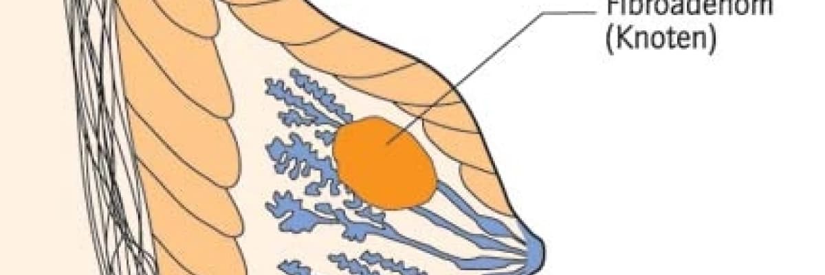 Fibroadenomlar