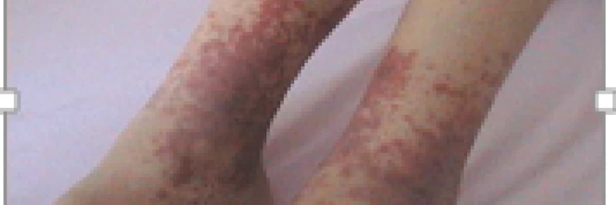 Henoch - Schöenlein Purpurası