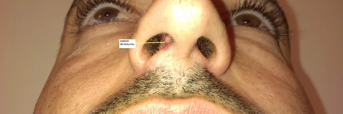 Burunda septum deviasyonu (Burun içi kemik eğriliği) ameliyatı neden gereklidir?