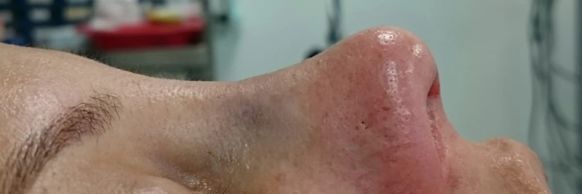 Burun estetiği nedir ve nasıl yapılır?