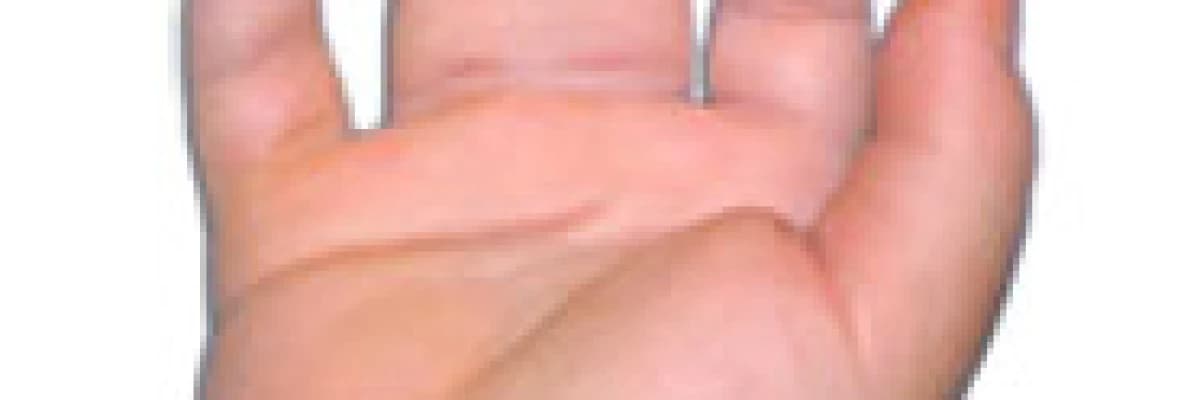 Yapışık parmak sendromu (Sindaktili)