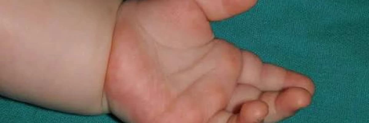 Fazla Parmak Sendromu ( Polidaktili )