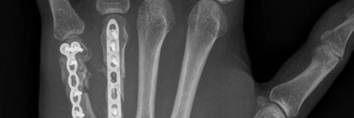 Elde Görülen Kırıklar