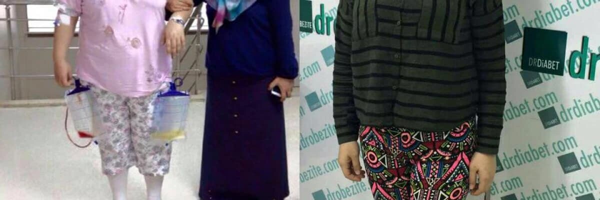 Metabolik Cerrahi Operasyonu Nasıl Uygulanır