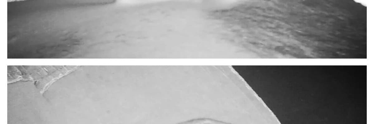 Kepçe Kulak (Belirigin Kulak) Düzeltilmesi (Otoplasti)