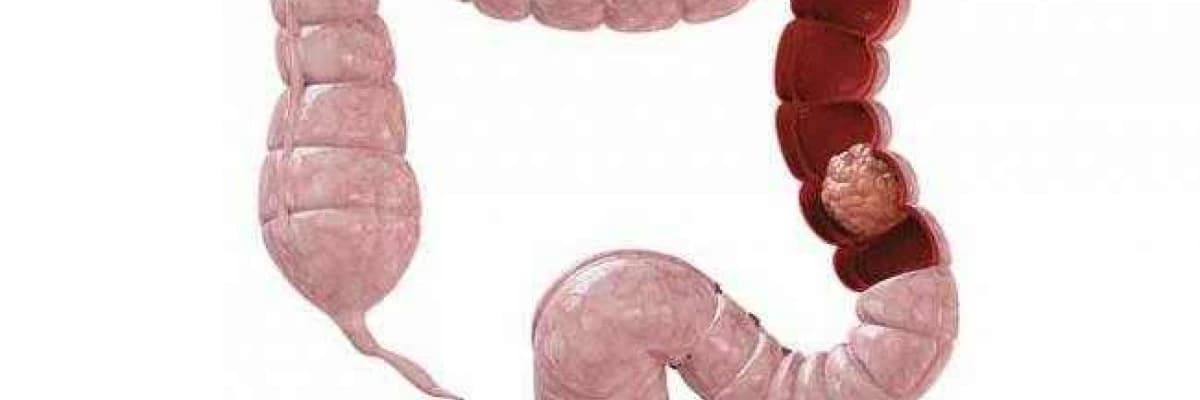 Kolon kanseri sıklığı artıyor mu?