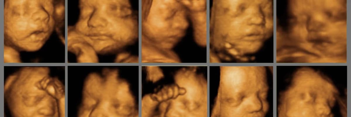 Ayrıntılı Ultrason (İleri Düzey Ultrason – Detaylı Ultrason) nedir? Neden yapılır?