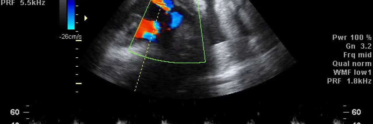 Doppler Ultrasonografi nedir?