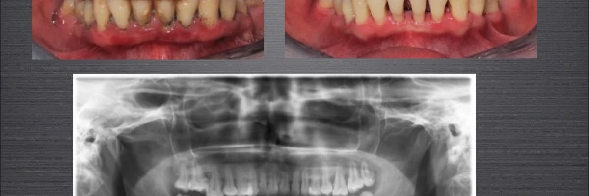 Dişeti İlltihabı ve Tedavisi