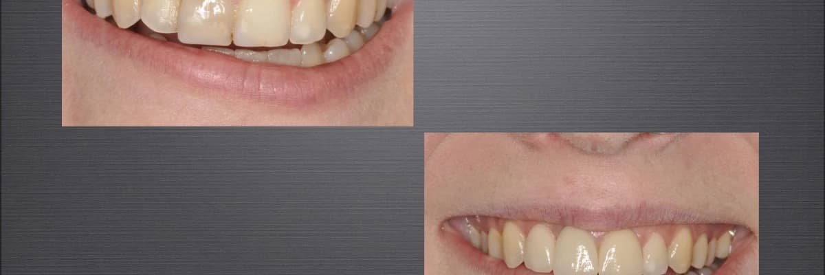 implant Uygulama Alanları