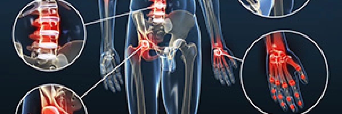 OSTEOARTRİT ( KİREÇLENME )