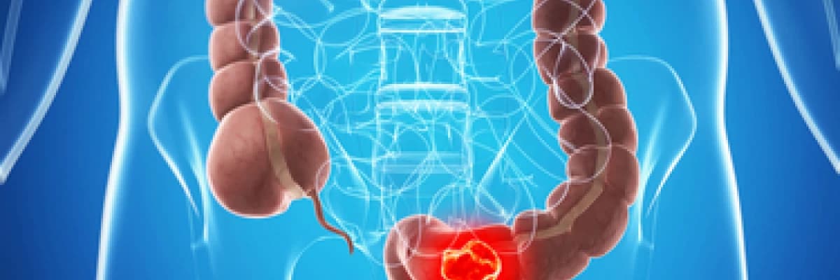 KALIN BARSAK KANAMALARI