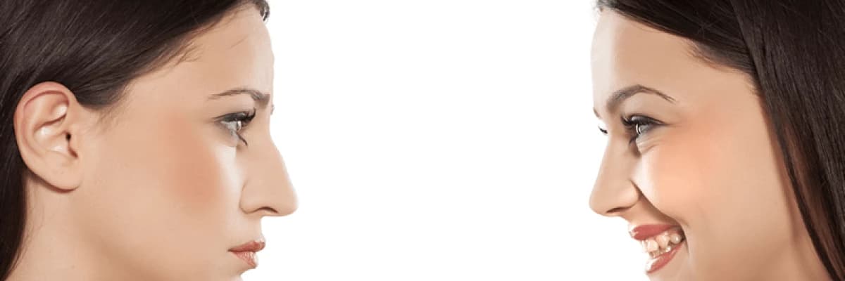 KEMERLİ BURUN AMELİYATI NEDİR?