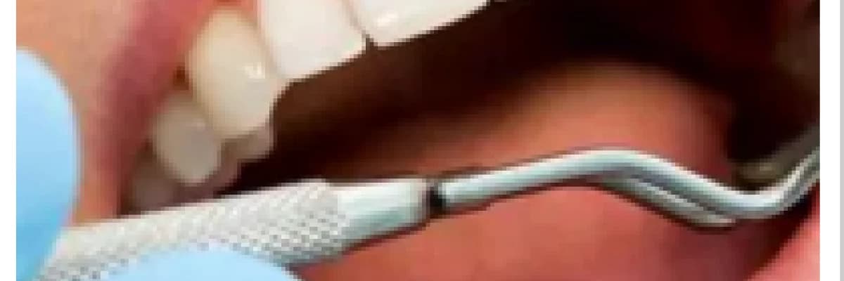 Estetik lamina diş kaplamalar