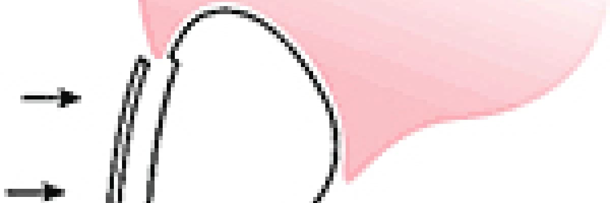 Laminate Veneer Tedavisi Hakkında Bilgiler