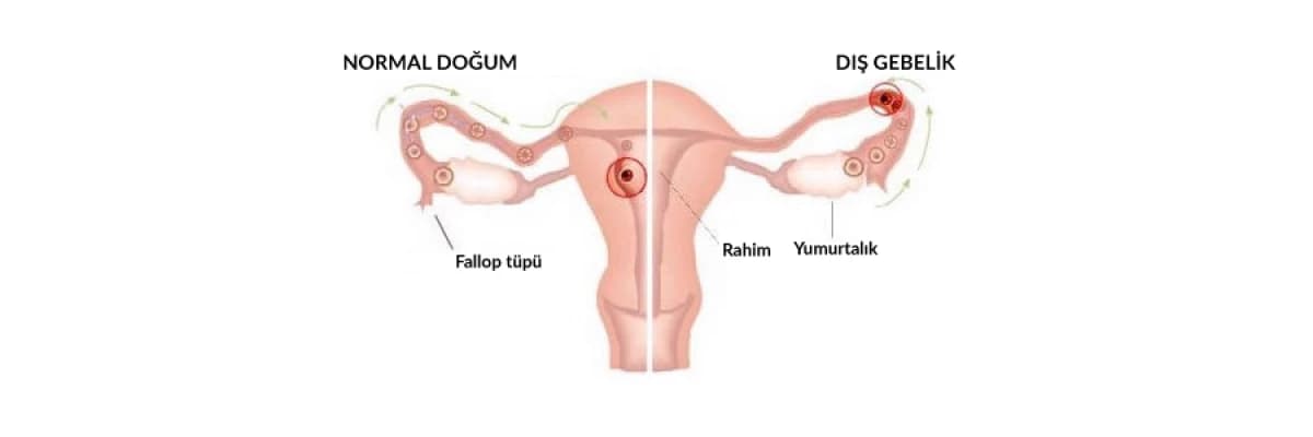 Dış Gebelik!!!