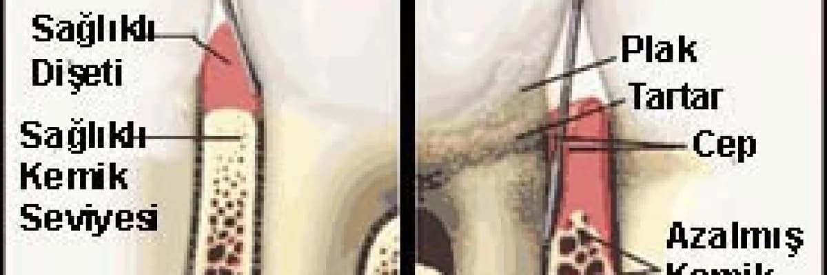 Dişeti Hastalıkları Tedavisi Hakkında Bilgiler