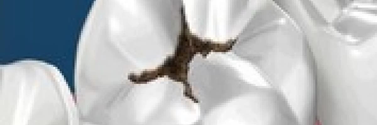 Diş çürükleri ve dolgu çeşitleri