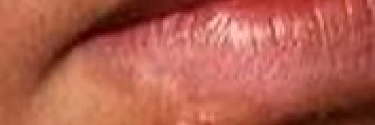 Diğer Ağız Hastalıkları