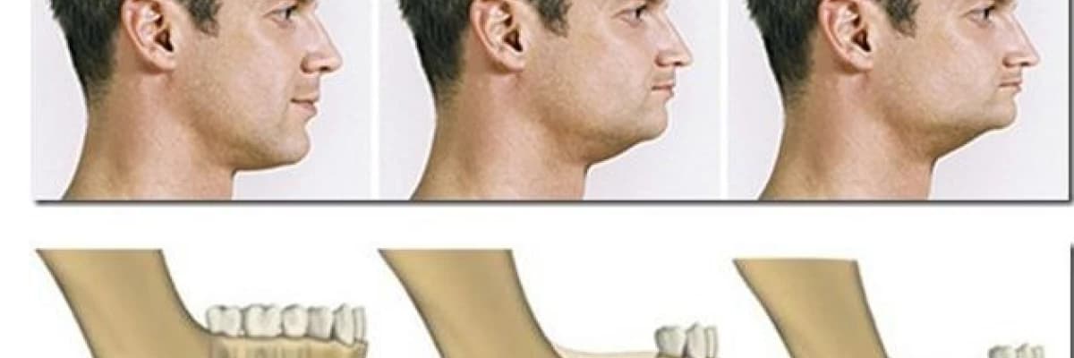 Çene kemiği erimesi