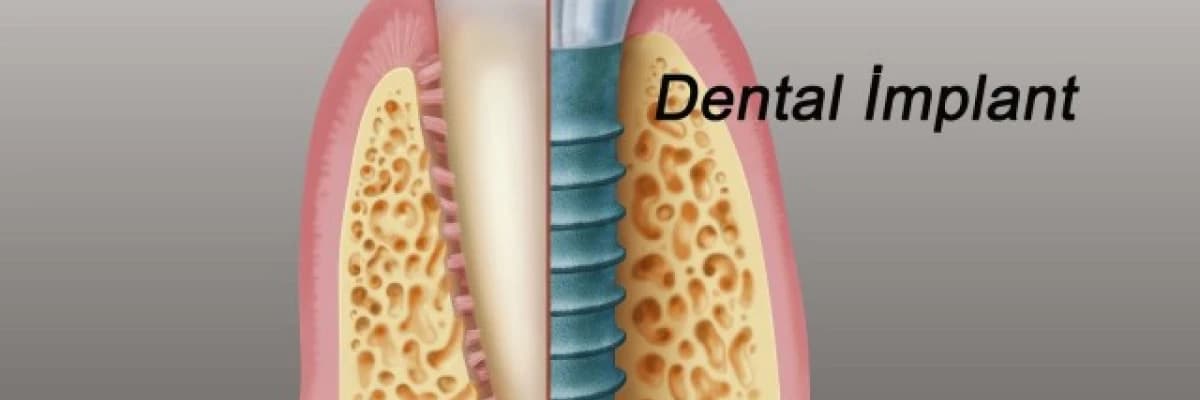Diş implantları her yaşta uygulanabilir mi?