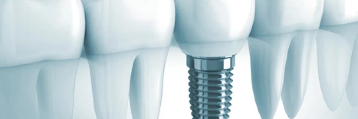 İmplant Tedavisi Uygulama Alanları