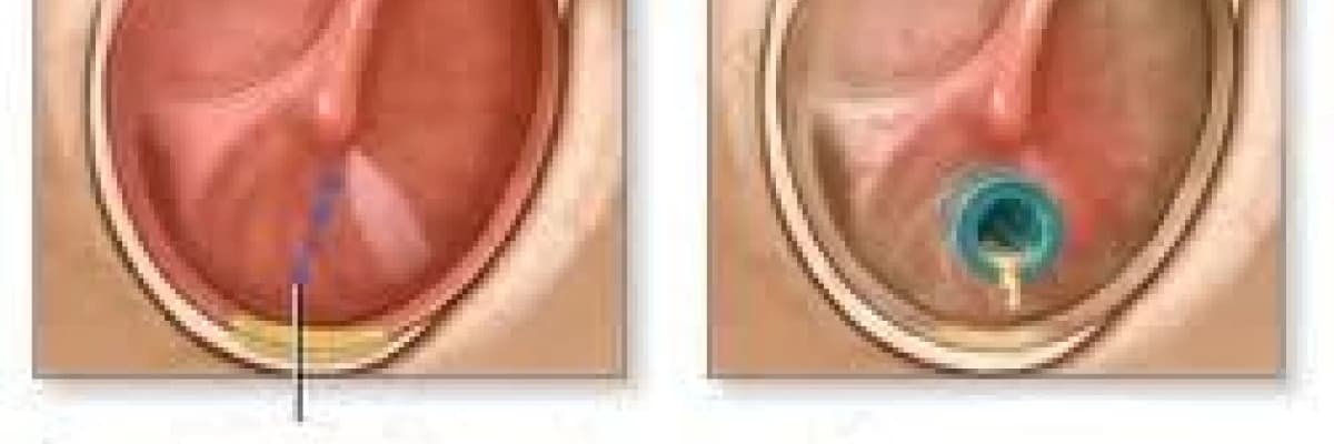 Kulak zarına tüp takılması