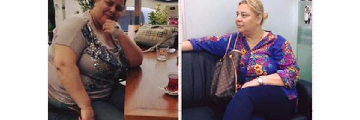 Neden Tüp Mide (Sleeve Gastrektomi) Ameliyatı ?