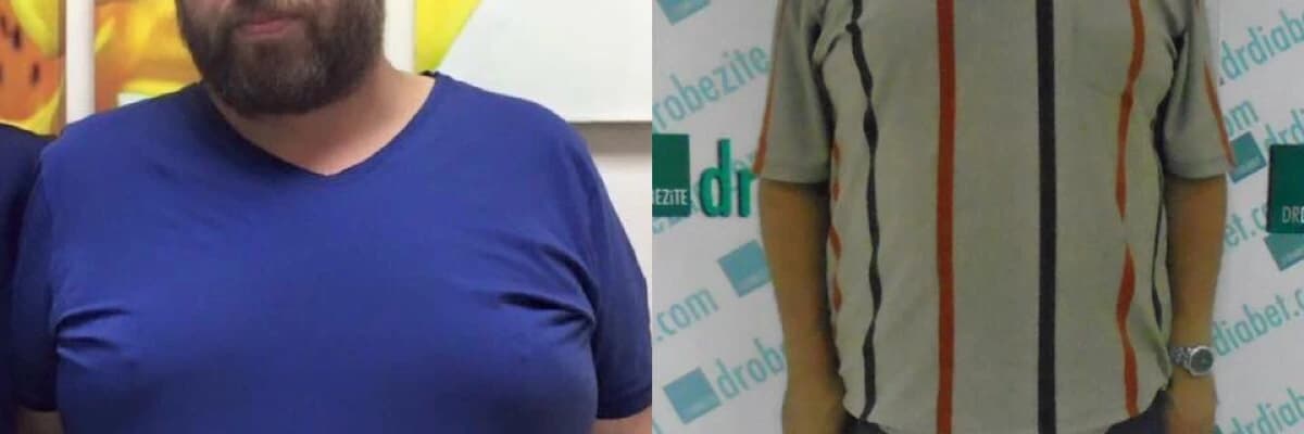 Obezite Cerrahisi Ve Karbonhidratların Seçimi