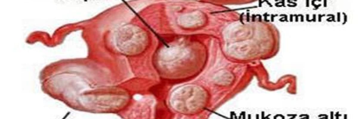 KAPALI (LAPAROSKOPİK) MYOM AMELİYATLARI