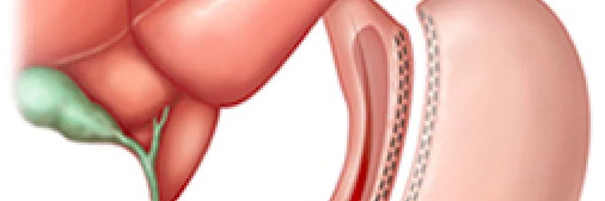Tüp Mide Ameliyatı – Sleeve Gastrectomy