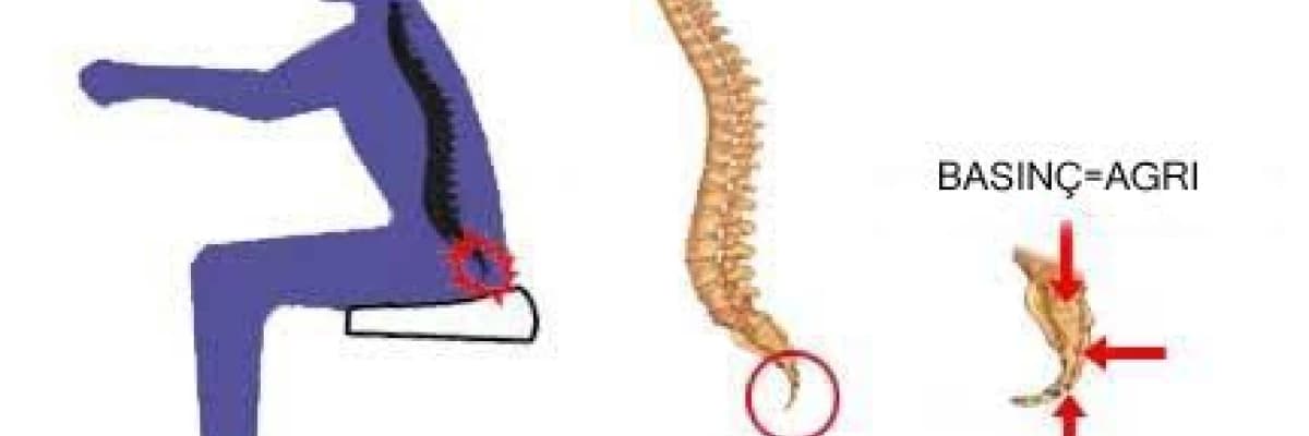 Kuyruk sokumu agrisi