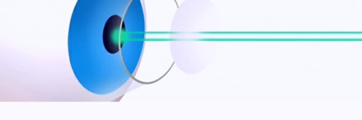 WHAT IS LASER EYE SURGERY?
