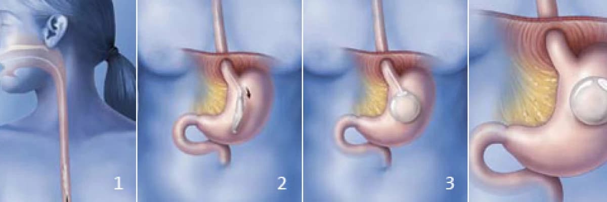 Obezitenin Ameliyatsız Tedavisinde Endoskopik Seçenek: Mide Balonu