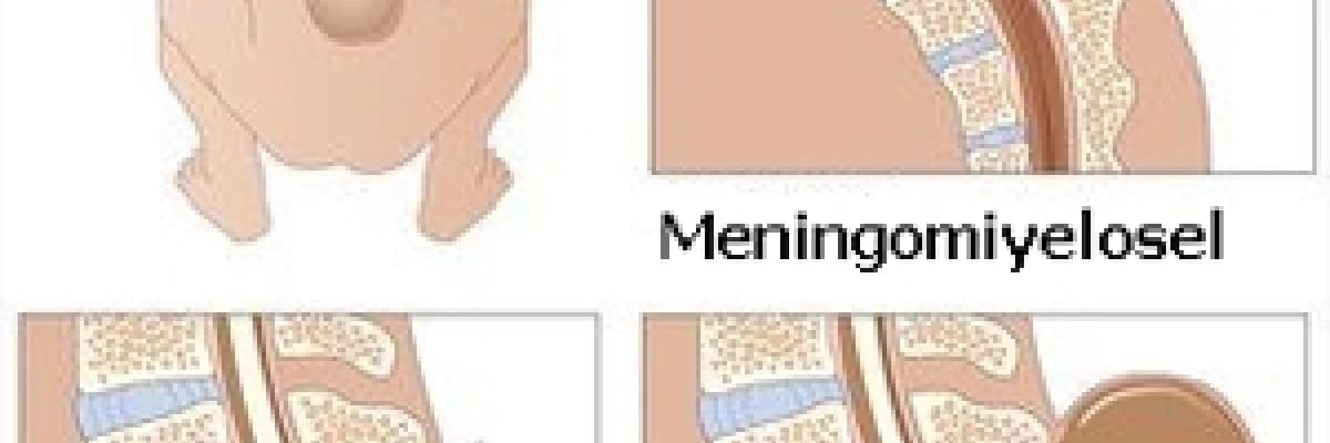 Spina Bifida nedir, nasıl oluşur, tedavisi nasıldır?
