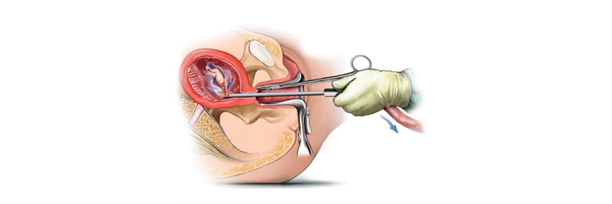 Vakum Aspirasyon Kürtaj