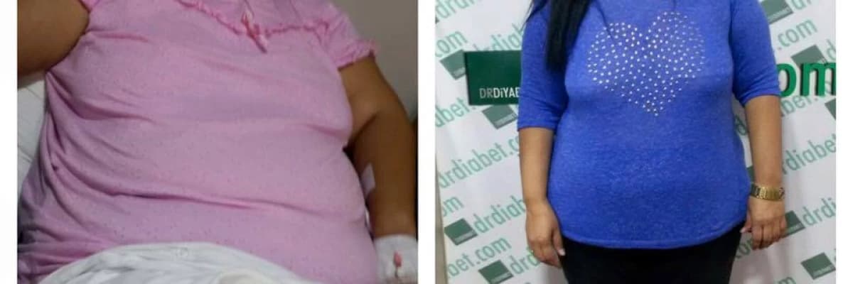 Obezite Cerrahisinin Psikolojik Etkileri