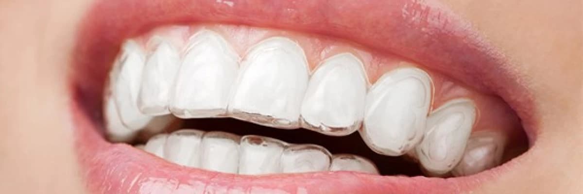 Ortodonti Nedir? Yetişkinlerde ve Çocuklarda Ortodonti