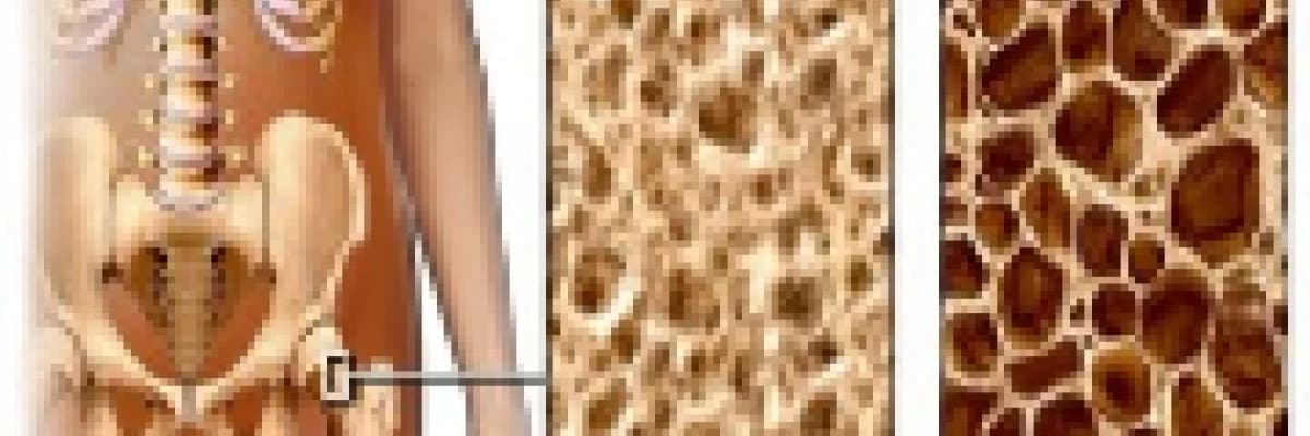 Osteoporoz Hakkında