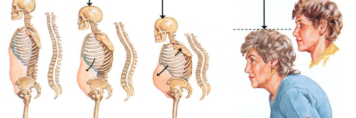 Osteoporoz ve Beslenme