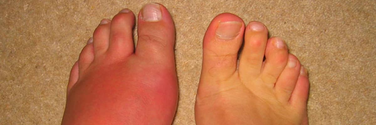 Gut Hastalığı ve Beslenme