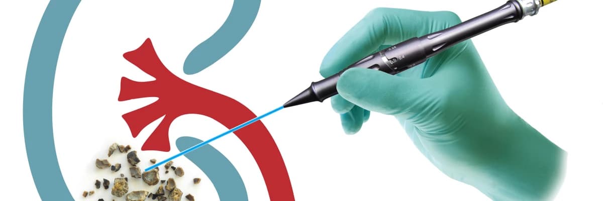 BÖBREK  ve ÜRETER TAŞLARINDA HOLMİYUM LAZER TEDAVİSİ